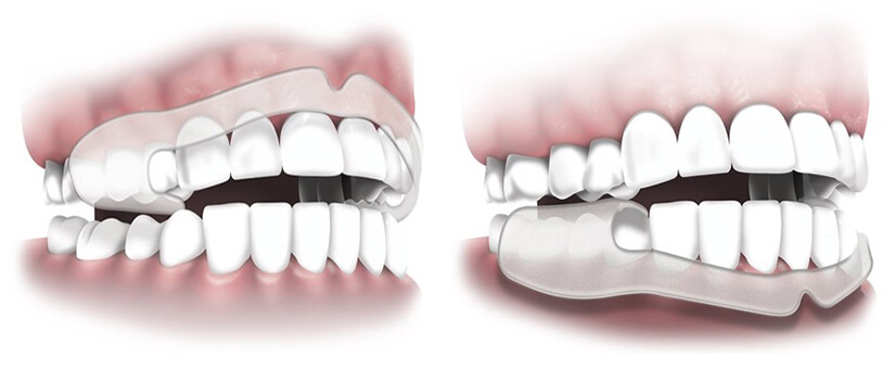 Plackers - Tänder